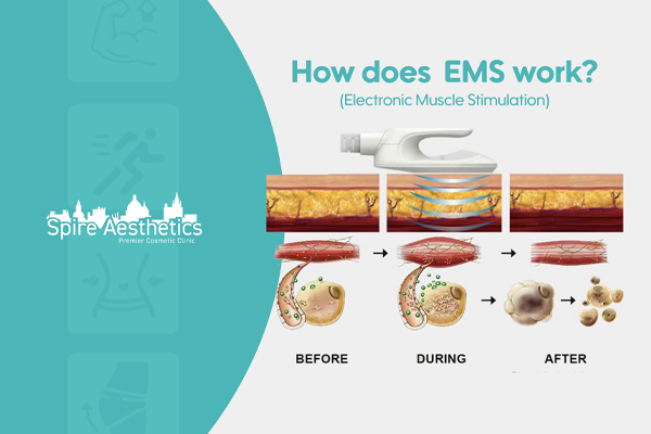 EMS treatment for post pregnancy weight loss treatment Thetford