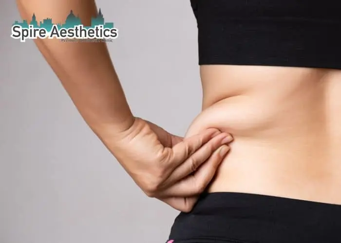 Image of woman pinching fat on their hips Thetford. Fat Freezing treatment