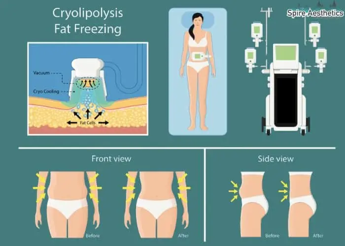 Fat freezing treatment Thetford benefits for competitions to remove stubborn fat deposits.