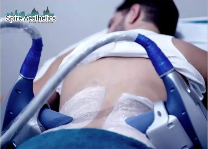 Man having fat freezing treatment done on love handles before a competitions Thetford to create a sculpted look.