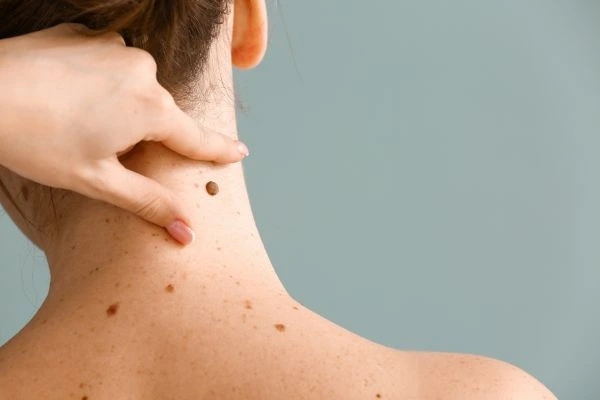 skin blemish removal Thetford treatment