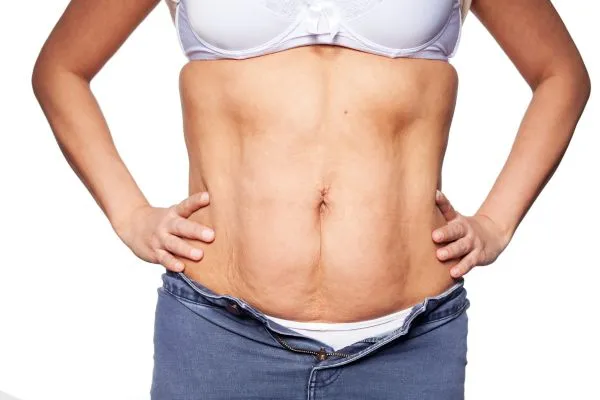 sagging skin on woman's stomach after weight loss injections Thetford