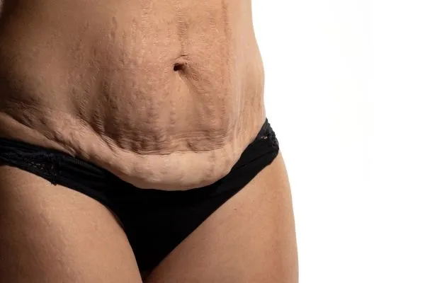 Image of womans stomach after weight loss injections Thetford showing saggy skin